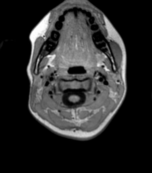 File:Choroid plexus carcinoma (Radiopaedia 91013-108553 Axial T1 4).jpg