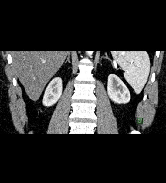 File:Chromophobe renal cell carcinoma (Radiopaedia 84286-99573 E 65).jpg