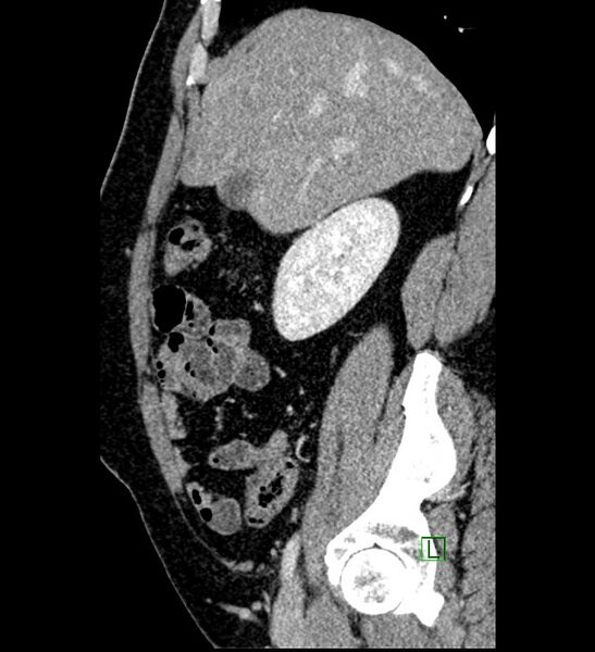 File:Chromophobe renal cell carcinoma (Radiopaedia 84286-99573 I 135).jpg