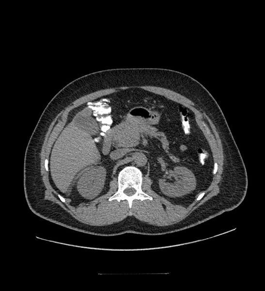 File:Chromophobe renal cell carcinoma (Radiopaedia 84337-99644 Axial non-contrast 34).jpg