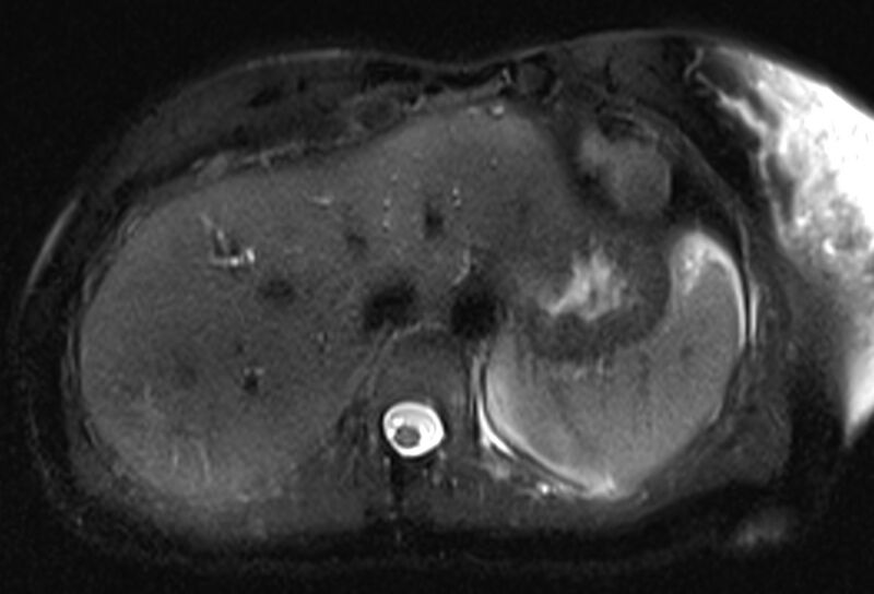 File:Chronic pancreatitis - pancreatic duct calculi (Radiopaedia 71818-82250 Axial T2 fat sat 12).jpg