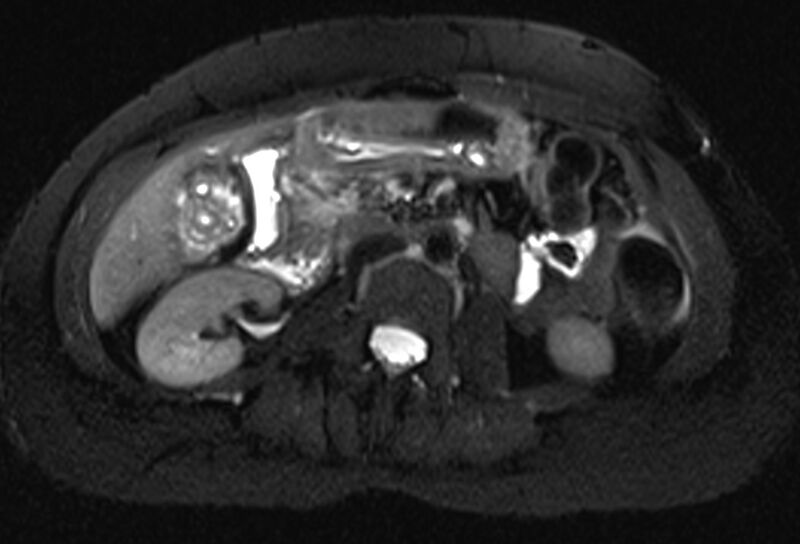 File:Chronic pancreatitis - pancreatic duct calculi (Radiopaedia 71818-82250 Axial T2 fat sat 38).jpg