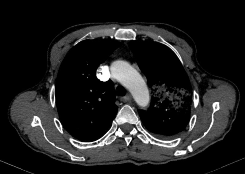 File:Chronic pulmonary embolism with bubbly consolidation (Radiopaedia 91248-108850 C+ arterial phase 35).jpg