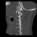 Clay-shoveler fracture (Radiopaedia 22568-22590 Sagittal bone window 9).jpg