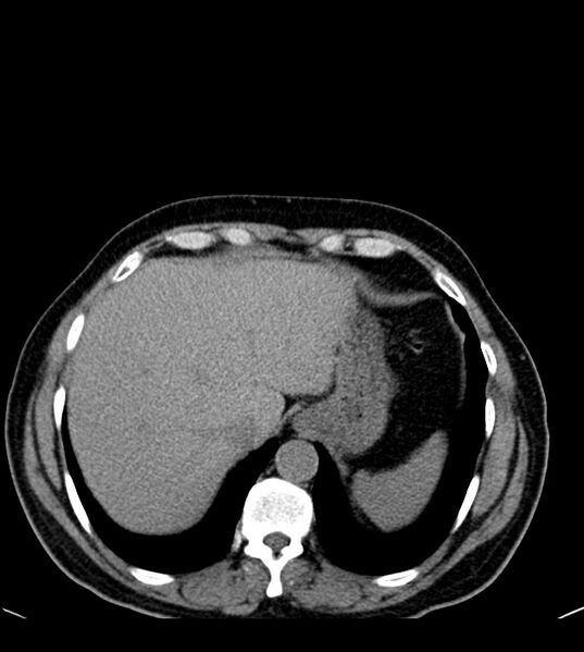 File:Clear cell renal cell carcinoma (Radiopaedia 85006-100539 Axial non-contrast 18).jpg