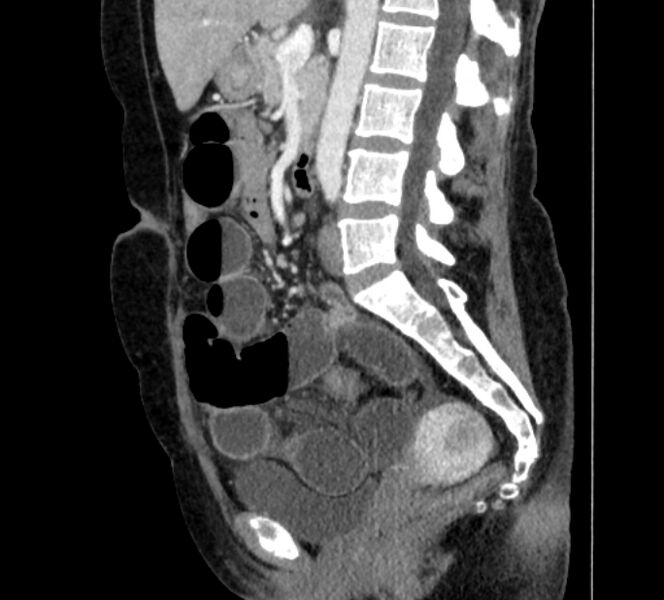File:Closed loop small bowel obstruction (Radiopaedia 71211-81508 C 77).jpg
