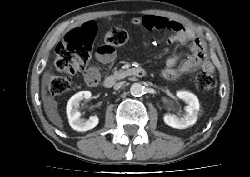 File:Closed loop small bowel obstruction with ischemia (Radiopaedia 84180-99456 A 49).jpg
