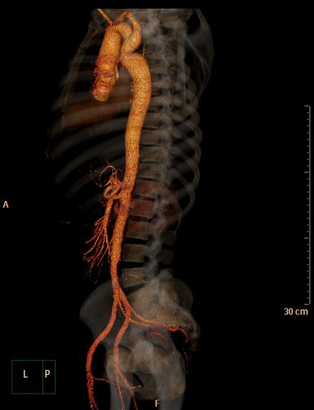 File:Coarctation of the aorta (Radiopaedia 49784-55050 3D VRT 16).jpg