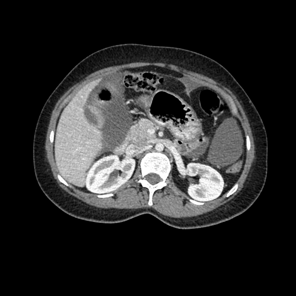 File:Cocoon abdomen with possible tubo-ovarian abscess (Radiopaedia 46235-50636 A 14).png
