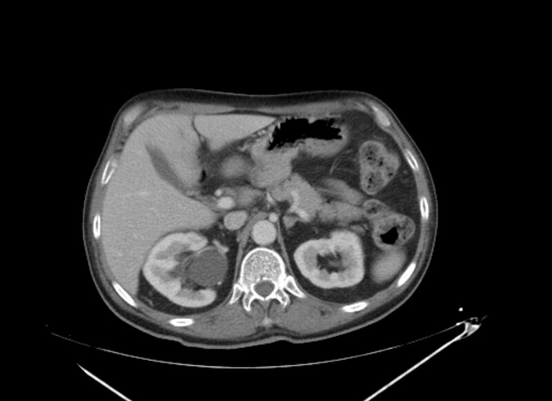 File:Colon cancer mimicking renal cell carcinoma (Radiopaedia 28986-29335 C 21).jpg