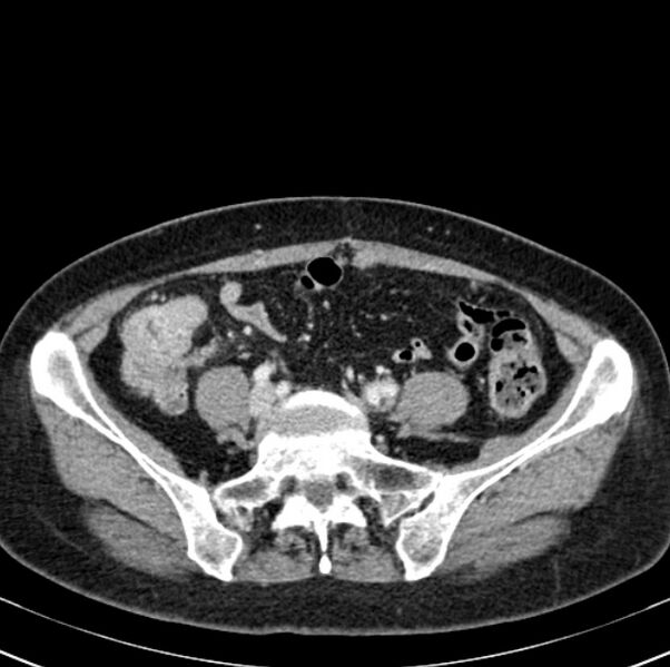 File:Colon carcinoma with hepatic metastases (Radiopaedia 29477-29961 A 80).jpg