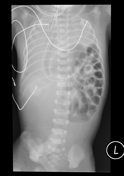 File:Congenital diaphragmatic hernia (Radiopaedia 9000).jpg