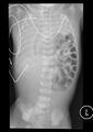 Congenital diaphragmatic hernia (Radiopaedia 9000).jpg