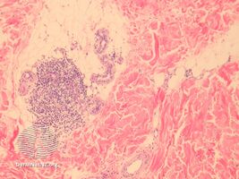 pathology-Lichen striatus