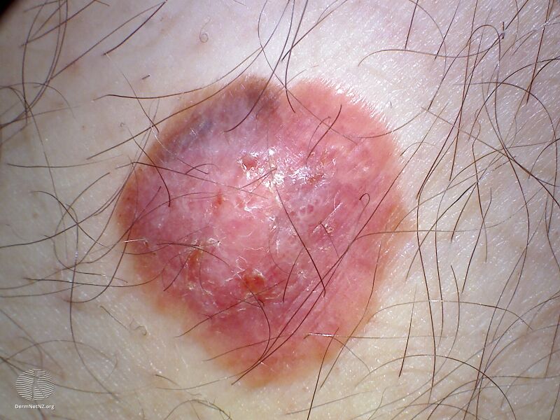 File:Macro image of amelanotic melanoma 5 (DermNet NZ amelanotic-melanoma4-macro2).jpg