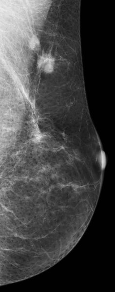 File:Multifocal IDC in a previously reduced breast (Radiopaedia 18777).jpg