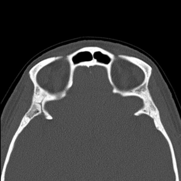 File:Nasal septal perforation (Radiopaedia 25030-25289 Axial bone window 57).jpg