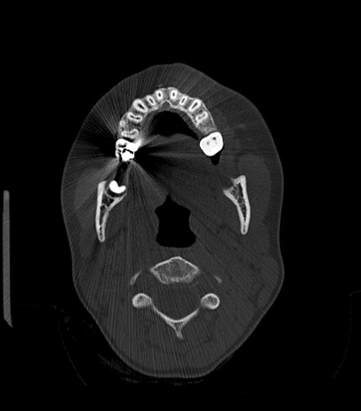 File:Nasoorbitoethmoid fracture (Radiopaedia 90044-107205 Axial 57).jpg
