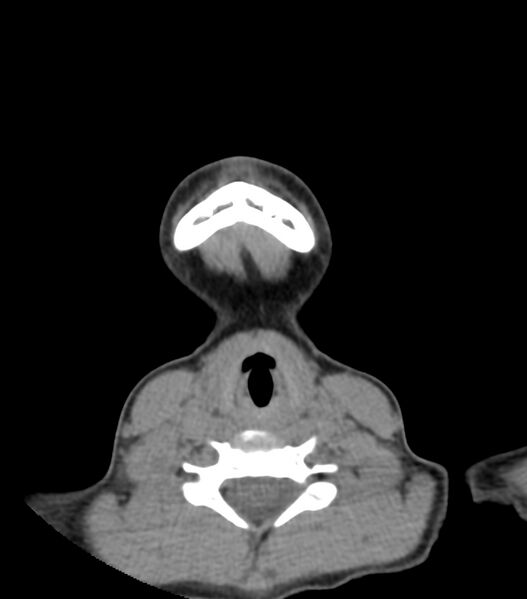 File:Nasoorbitoethmoid fracture (Radiopaedia 90044-107205 Axial non-contrast 25).jpg