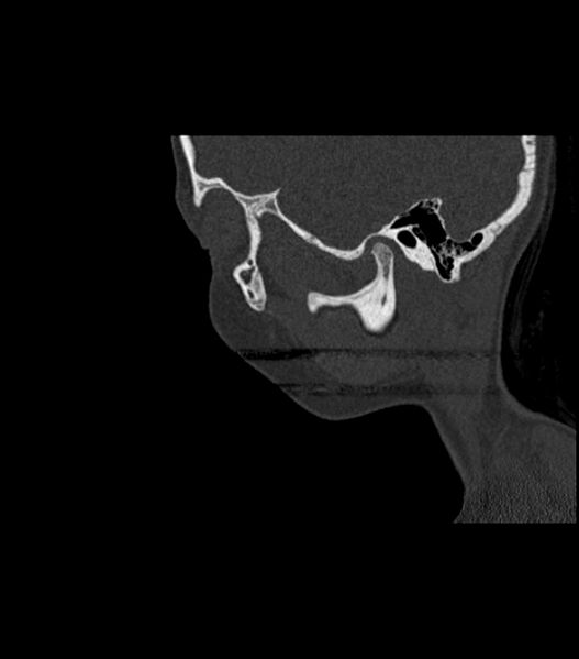 File:Nasoorbitoethmoid fracture (Radiopaedia 90044-107205 Sagittal bone window 115).jpg