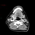 Nasopharyngeal lymphoma (Radiopaedia 54235-60432 A 40).jpg