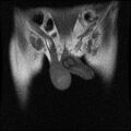 Necrotizing epididymo-orchitis with intra-testicular abscess (Radiopaedia 29397-29860 Coronal T1 5).jpg