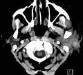 Necrotizing otitis externa (Radiopaedia 19938-19971 Axial non-contrast 2).jpg