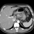 Necrotizing pancreatitis with acute necrotic collection (Radiopaedia 14470-14417 B 5).jpg
