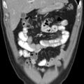 Necrotizing pancreatitis with acute necrotic collection (Radiopaedia 14470-14417 C 6).jpg