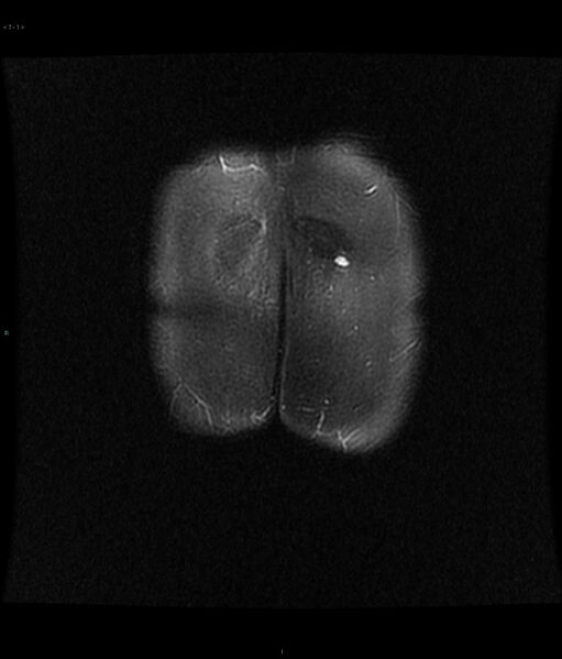 File:Neurofibromatosis type 1 (Radiopaedia 36933-38560 Coronal STIR 1).jpg