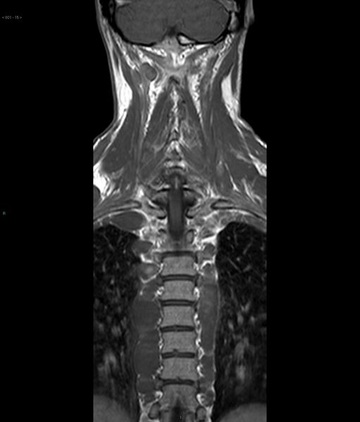 File:Neurofibromatosis type 1 (Radiopaedia 36933-38560 Coronal T1 15).jpg