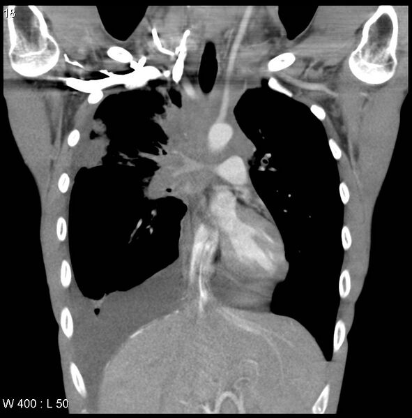 File:Non-Hodgkin lymphoma involving lung (Radiopaedia 29094-29470 C 12).jpg