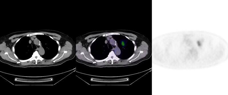 File:Non-Hodgkin lymphoma involving seminal vesicles with development of interstitial pneumonitis during Rituximab therapy (Radiopaedia 32703-33752 ax CT Fus PET 17).jpg