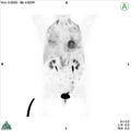Non-Hodgkin lymphoma involving seminal vesicles with development of interstitial pneumonitis during Rituximab therapy (Radiopaedia 32703-33761 PET cor 3D MIP 1).jpg