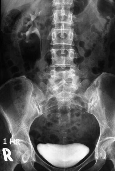File:Non-functioning kidney on intravenous urography (Radiopaedia 22970-23000 E 1).jpg