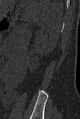 Normal CT lumbar spine (Radiopaedia 53981-60118 Sagittal bone window 101).jpg