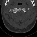 Normal CT of the cervical spine (Radiopaedia 53322-59305 Axial bone window 67).jpg