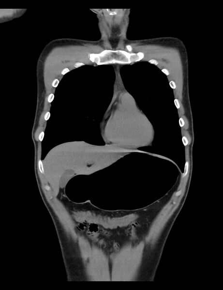 File:Normal CT virtual gastroscopy (Radiopaedia 29960-30501 E 18).jpg