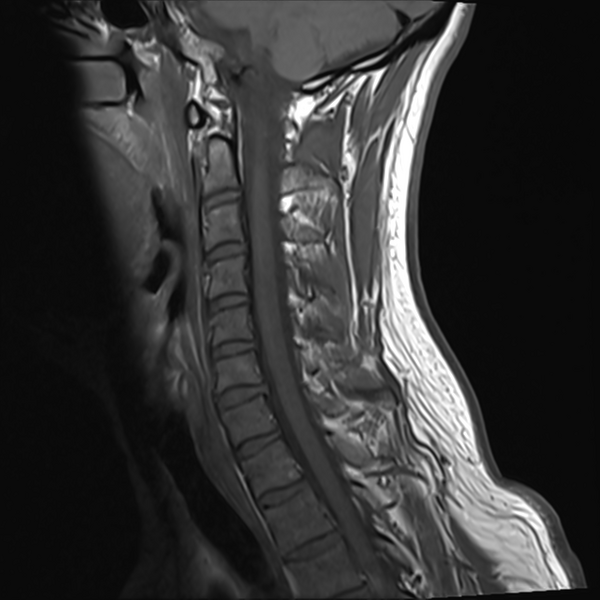File:Normal MRI cervical spine (infection protocol) (Radiopaedia 53916-60039 Sagittal T1 6).png