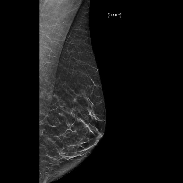 File:Normal breast mammography (tomosynthesis) and ultrasound (Radiopaedia 65325-74353 LMLO C-view 1).jpeg