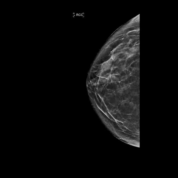 File:Normal breast mammography (tomosynthesis) and ultrasound (Radiopaedia 65325-74353 RCC C-view 1).jpeg