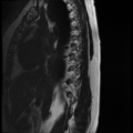 Normal cervical and thoracic spine MRI (Radiopaedia 35630-37156 G 12).png