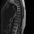 Normal cervical and thoracic spine MRI (Radiopaedia 35630-37156 G 4).png