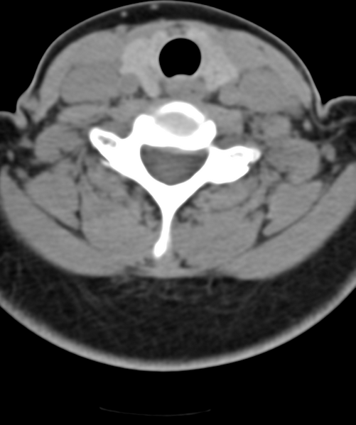 File:Normal cervical spine MRI (including Dixon) (Radiopaedia 42762-45926 Axial non-contrast 42).png