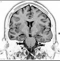 Normal coronal brain (Radiopaedia 6676-7910 B 21).jpg