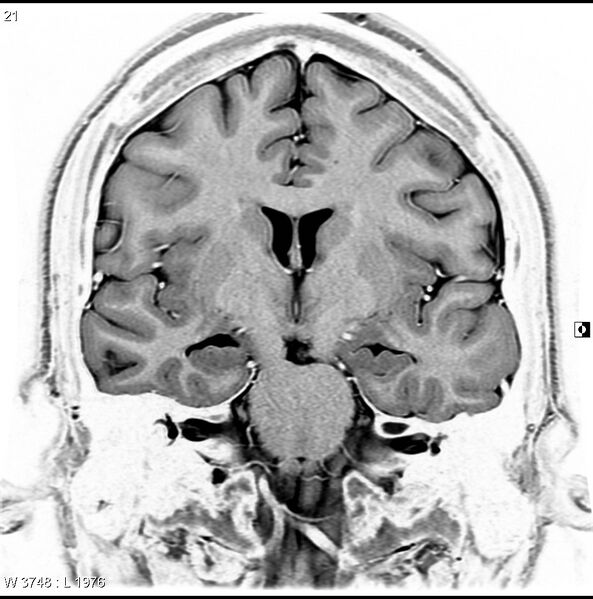 File:Normal coronal brain (Radiopaedia 6676-7910 B 21).jpg