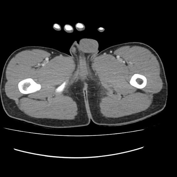File:Normal dual-phase trauma CT chest,abdomen and pelvis (Radiopaedia 48092-52899 A 124).jpg