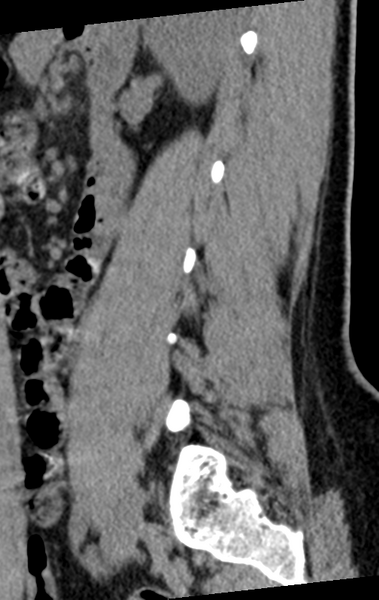 File:Normal lumbar spine CT (Radiopaedia 46533-50986 C 26).png
