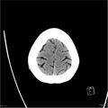 Normal pressure hydrocephalus (Radiopaedia 24415-24736 Axial non-contrast 21).jpg
