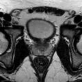 Normal prostate (MRI) (Radiopaedia 29986-30535 Axial T2 11).jpg